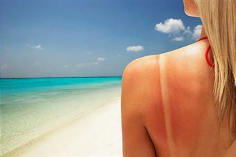 Sunburn causes treatment prevention symptoms