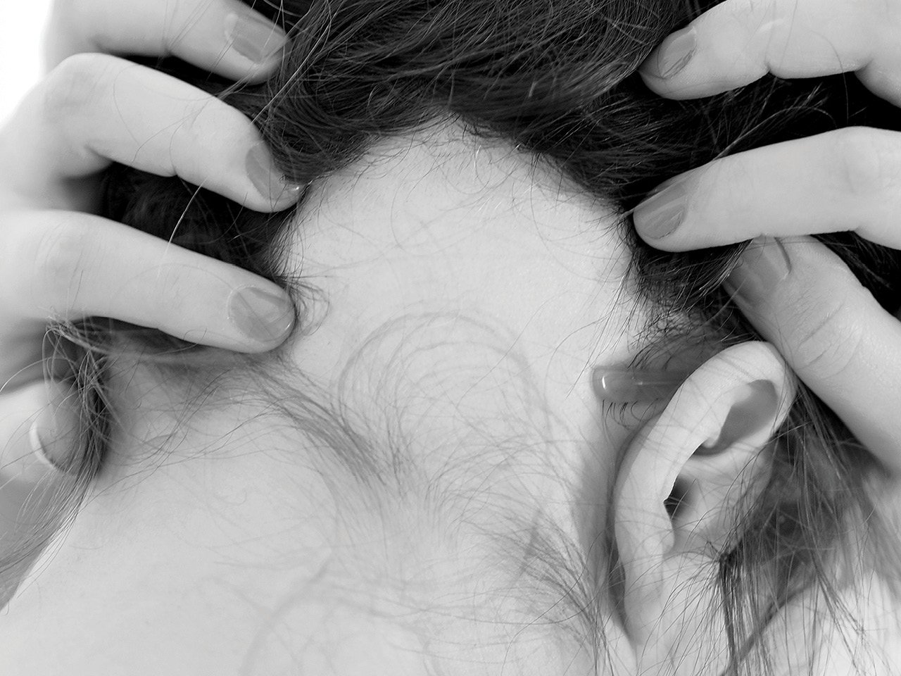 A large bald patch caused by alopecia areata.