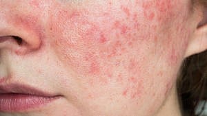 A woman's cheek shown with redness as a result of rosacea for an article that explains what is rosacea and how to treat it.