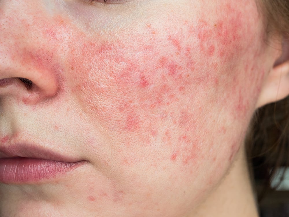 A woman's cheek shown with redness as a result of rosacea for an article that explains what is rosacea and how to treat it.