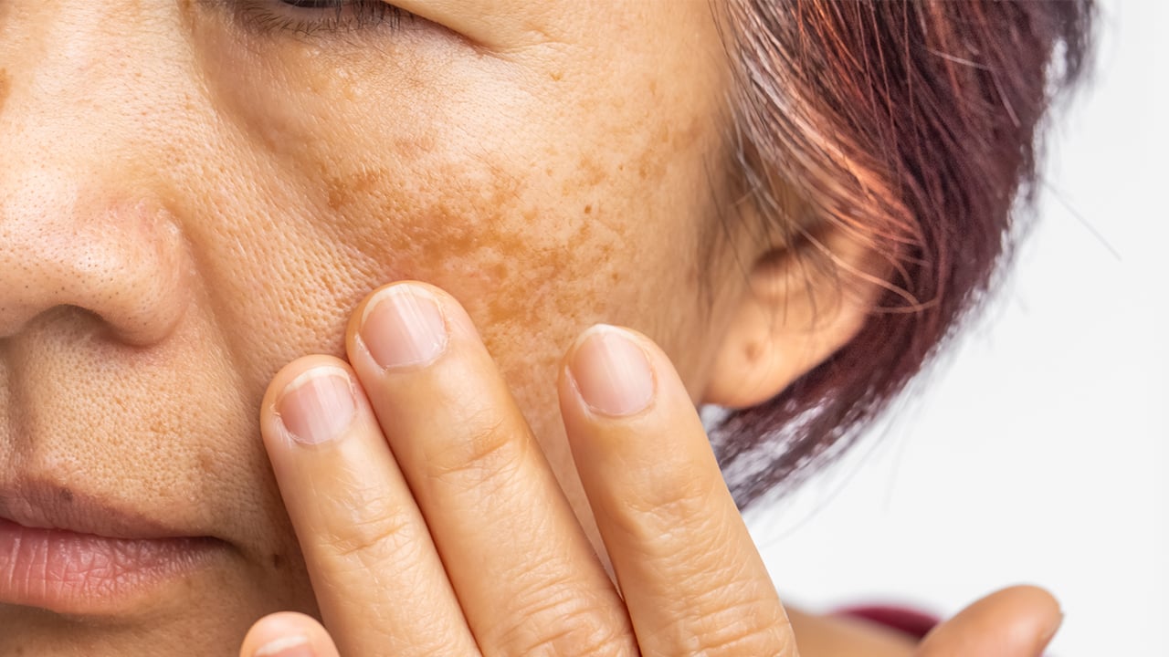 A close-up of a woman's cheek showing hyperpigmentation and melasma.